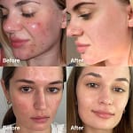 Ser cu acid succinic, red acne succinic acid peel, medicube, 40g - Imagine 3